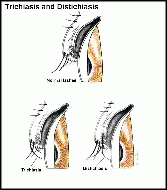 Distichiasis